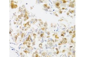 Immunohistochemistry of paraffin-embedded Human liver cancer using MYO5A Polyclonal Antibody at dilution of 1:100 (40x lens). (MYO5A 抗体)