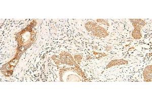 Immunohistochemistry of paraffin-embedded Human esophagus cancer tissue using MT-CO2 Polyclonal Antibody at dilution of 1:60(x200) (COX2 抗体)