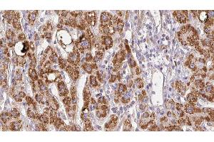 ABIN6278511 at 1/100 staining Human liver cancer tissue by IHC-P. (SLC26A5 抗体  (Internal Region))