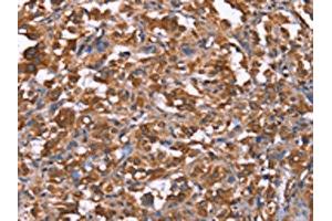 The image on the left is immunohistochemistry of paraffin-embedded Human thyroid cancer tissue using ABIN7191000(HRASLS2 Antibody) at dilution 1/40, on the right is treated with synthetic peptide. (HRASLS2 抗体)