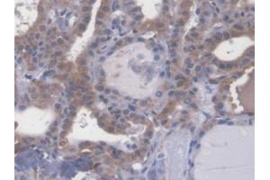 DAB staining on IHC-P; Samples: Human Thyroid cancer Tissue (Esophageal Cancer Related Gene 4 (AA 32-148) 抗体)