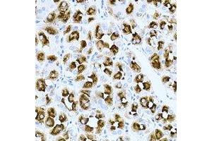 Immunohistochemical analysis of Rac 1 staining in human gastric cancer formalin fixed paraffin embedded tissue section. (RAC1 抗体)