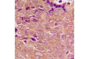 Immunohistochemical analysis of PSMC3 staining in human breast cancer formalin fixed paraffin embedded tissue section.