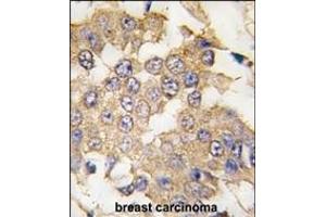 Formalin-fixed and paraffin-embedded human breast carcinoma tissue reacted with ERK2 antibody (C-term) (ABIN391720 and ABIN2841610) , which was peroxidase-conjugated to the secondary antibody, followed by DAB staining. (ERK2 抗体  (C-Term))