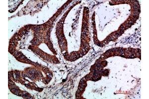 Immunohistochemical analysis of paraffin-embedded human-colon-cancer, antibody was diluted at 1:200. (GREM2 抗体  (AA 71-120))