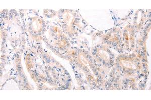 Immunohistochemistry of paraffin-embedded Human thyroid cancer using EDG3 Polyclonal Antibody at dilution of 1:30 (S1PR3 抗体)