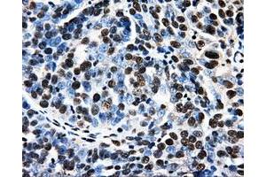 Immunohistochemical staining of paraffin-embedded Adenocarcinoma of breast tissue using anti-PSMC3 mouse monoclonal antibody. (PSMC3 抗体)
