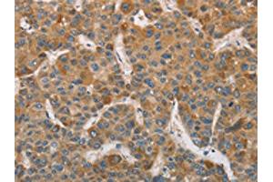The image on the left is immunohistochemistry of paraffin-embedded Human liver cancer tissue using ABIN7129185(DDX53 Antibody) at dilution 1/75, on the right is treated with fusion protein. (DDX53 抗体)