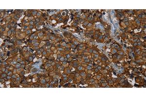 Immunohistochemistry of paraffin-embedded Human breast cancer using ERBB4 Polyclonal Antibody at dilution of 1:40 (ERBB4 抗体)