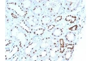 IHC testing of FFPE human renal cell carcinoma with PAX8 antibody (clone PAX8/1492). (PAX8 抗体  (AA 60-261))