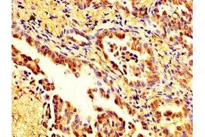 IHC image of ABIN7160125 diluted at 1:200 and staining in paraffin-embedded human lung cancer performed on a Leica BondTM system. (Moesin 抗体  (AA 466-572))