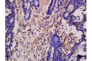 Formalin-fixed and paraffin embedded human colon carcinoma labeled with Rabbit Anti-DGKH Polyclonal Antibody, Unconjugated  at 1:200 followed by conjugation to the secondary antibody and DAB staining (DGKH 抗体  (AA 51-150))