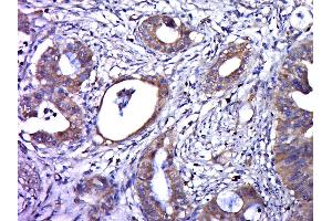 Paraformaldehyde-fixed, paraffin embedded human cervical cancer, Antigen retrieval by boiling in sodium citrate buffer (pH6. (人 Papilloma Virus 16 E6 (HPV-16 E6) (AA 85-158) 抗体)