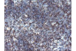 Immunohistochemical staining of paraffin-embedded Human lymphoma tissue using anti-DPH2 mouse monoclonal antibody. (DPH2 抗体)