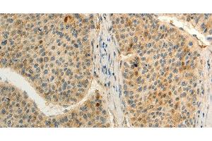 Immunohistochemistry of paraffin-embedded Human liver cancer tissue using FZD8 Polyclonal Antibody at dilution 1:50 (FZD8 抗体)