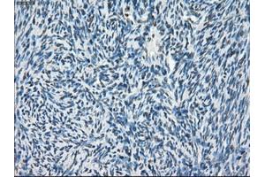 Immunohistochemical staining of paraffin-embedded Adenocarcinoma of breast tissue using anti-POR mouse monoclonal antibody. (POR 抗体)