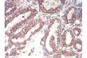 Immunohistochemical analysis of paraffin-embedded esophageal cancer tissues using CSF3 mouse mAb with DAB staining. (G-CSF 抗体  (AA 1-207))