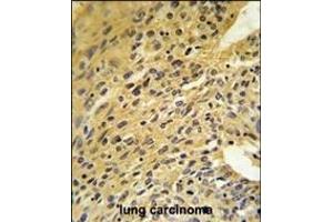 COQ5 Antibody (Center) (ABIN653267 and ABIN2842785) IHC analysis in formalin fixed and paraffin embedded human lung carcinoma followed by peroxidase conjugation of the secondary antibody and DAB staining. (COQ5 抗体  (AA 213-241))