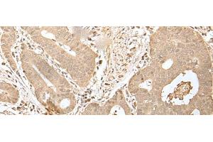 Immunohistochemistry of paraffin-embedded Human gastric cancer tissue using HDHD2 Polyclonal Antibody at dilution of 1:40(x200) (HDHD2 抗体)