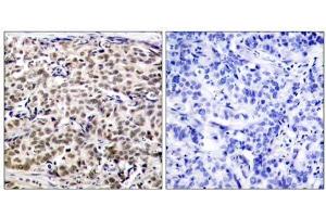Immunohistochemical analysis of paraffin-embedded human breast carcinoma tissue using CREB (Ab-129) antibody (E021265). (CREB1 抗体)