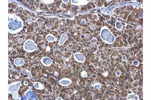 IHC-P Image SP1 antibody detects SP1 protein at nucleus on human gastric carcinoma by immunohistochemical analysis. (SP1 抗体  (C-Term))
