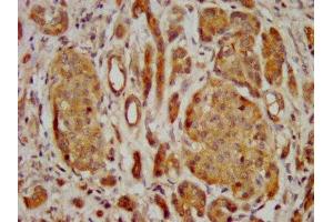 IHC image of ABIN7153155 diluted at 1:400 and staining in paraffin-embedded human pancreatic cancer performed on a Leica BondTM system. (FREM2 抗体  (AA 1986-2127))