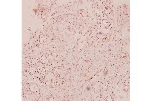 Immunohistochemistry analysis of RANTES Antibody in paraffin-embedded human breast carcinoma tissue at 1/100. (CCL5 抗体)