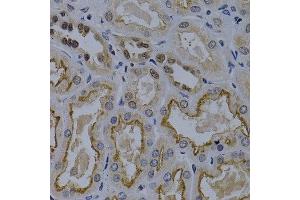 Immunohistochemistry of paraffin-embedded human kidney cancer using TNFRSF6B antibody at dilution of 1:200 (400x lens). (TNFRSF6B 抗体)