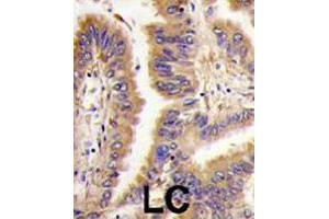 Formalin-fixed and paraffin-embedded human lung carcinoma tissue reacted with TGM2 polyclonal antibody  , which was peroxidase-conjugated to the secondary antibody, followed by DAB staining. (Transglutaminase 2 抗体  (Internal Region))