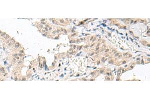 Immunohistochemistry of paraffin-embedded Human thyroid cancer tissue using GFI1B Polyclonal Antibody at dilution of 1:80(x200) (GFI1B 抗体)