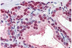 Human Prostate (formalin-fixed, paraffin-embedded) stained with  antibody ABIN462276 followed by biotinylated secondary antibody, alkaline phosphatase-streptavidin and chromogen. (CRABP1 抗体  (AA 1-137))