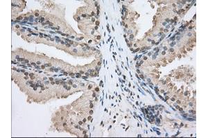 Immunohistochemical staining of paraffin-embedded Adenocarcinoma of Human ovary tissue using anti-SNX9 mouse monoclonal antibody. (SNX9 抗体)