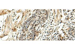 Immunohistochemistry of paraffin-embedded Human esophagus cancer tissue using NUTF2 Polyclonal Antibody at dilution of 1:110(x200) (NUTF2 抗体)