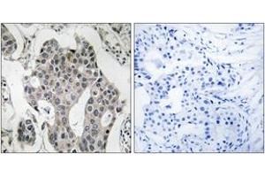 Immunohistochemistry analysis of paraffin-embedded human breast carcinoma tissue, using RAB3GAP2 Antibody. (RAB3GAP2 抗体  (AA 417-466))