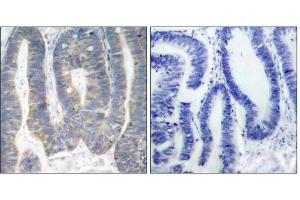 Immunohistochemical analysis of paraffin-embedded human colon carcinoma tissue using PKR (Ab-451) antibody (E021282). (EIF2AK2 抗体)