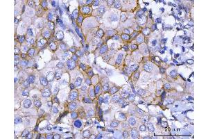 IHC analysis of HER2/ERBB2 using anti-HER2/ERBB2 antibody (ABIN7602717).