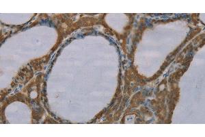 Immunohistochemistry of paraffin-embedded Human thyroid cancer tissue using S100A6 Polyclonal Antibody at dilution 1:35
