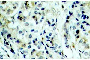 Immunohistochemistry of paraffin-embedded Human breast carcinoma using Phospho-HDAC5(S498) Polyclonal Antibody (HDAC5 抗体  (pSer498))