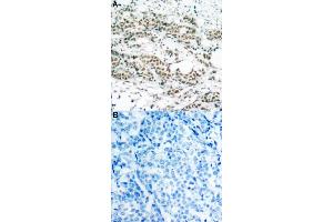 Immunohistochemical staining of human breast cancer tissue by FOXO4 (phospho S197) polyclonal antibody  without blocking peptide (A) or preincubated with blocking peptide (B) under 1:50-1:100 dilution. (FOXO4 抗体  (pSer197))