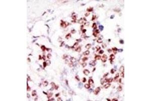 Formalin-fixed and paraffin-embedded human cancer tissue reacted with the primary antibody, which was peroxidase-conjugated to the secondary antibody, followed by DAB staining. (TLK1 抗体  (C-Term))