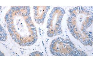 Immunohistochemistry of paraffin-embedded Human colon cancer using PAK1 Polyclonal Antibody at dilution of 1:40 (PAK1 抗体)