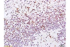 Formalin-fixed and paraffin embedded human gastric carcinoma labeled with Anti-XRCC1 Polyclonal Antibody, Unconjugated (ABIN673539) at 1:200 followed by conjugation to the secondary antibody and DAB staining.