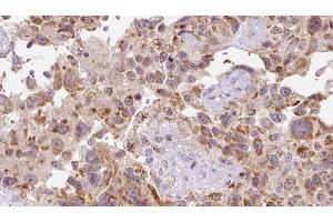 ABIN6273118 at 1/100 staining Human Melanoma tissue by IHC-P. (FSTL1 抗体  (N-Term))