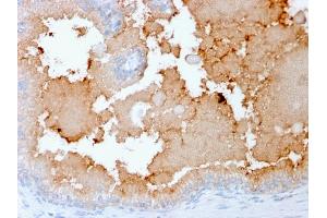 Formalin-fixed, paraffin-embedded human Prostate Carcinoma stained with AMACR Recombinant Mouse Monoclonal Antibody (rAMACR/1864). (Recombinant AMACR 抗体  (AA 297-394))