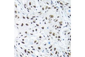 Immunohistochemistry of paraffin-embedded human esophageal cancer using SNRP Rabbit pAb (2161) at dilution of 1:200 (40x lens). (SNRPA1 抗体  (AA 1-220))