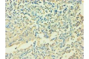 Immunohistochemistry of paraffin-embedded human cervical cancer using ABIN7156922 at dilution of 1:100