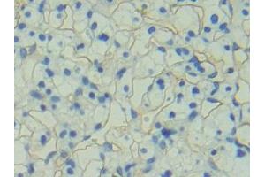 Detection of PODXL in Human Renal cancer Tissue using Polyclonal Antibody to Podocalyxin (PODXL) (PODXL 抗体  (AA 220-431))