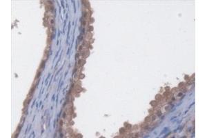 Detection of EEF2 in Human Prostate Tissue using Polyclonal Antibody to Eukaryotic Translation Elongation Factor 2 (EEF2) (EEF2 抗体  (AA 32-233))