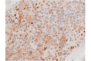 ABIN6267525 at 1/200 staining Human liver cancer tissue sections by IHC-P. (GATA4 抗体  (pSer262))