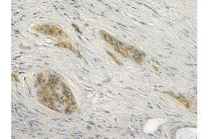 ABIN6266372 and ABIN6277338 at 1/100 staining human pancreatic carcinoma by IHC-P. (CDH23 抗体  (N-Term))